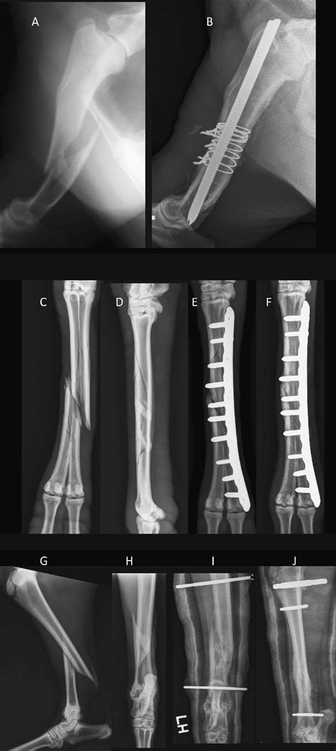 Examples of surgical repair techniques A-Comminuted diaphyseal fracture... | Download Scientific ...