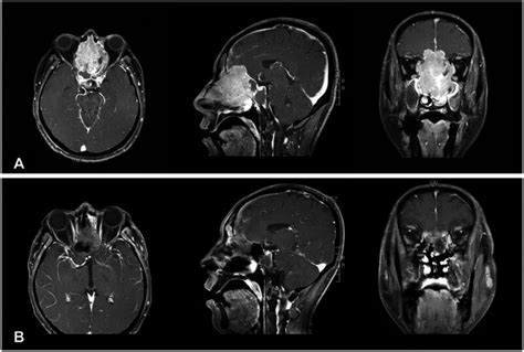 [DIAGRAM] Diagram Of Sinuses Mri - MYDIAGRAM.ONLINE