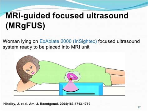 Pin by MRgFUS on Non-invasive Uterine Fibroid treatment | Fibroids, The unit, Ultrasound