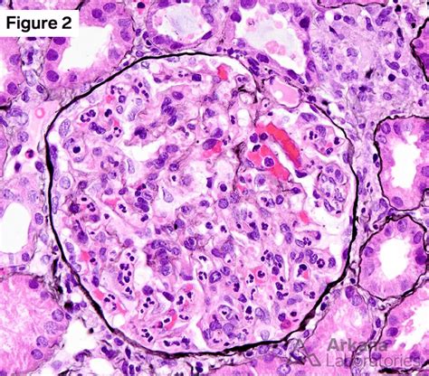 Post-Streptococcal Acute Glomerulonephritis (PSAGN) | Case 7