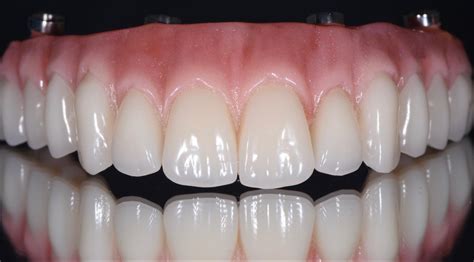 All-on-4® treatment concept vs. Dentures and Bridges | Next Smile