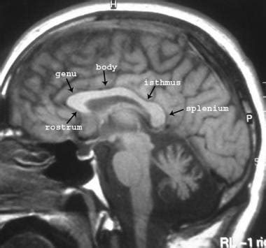 You should probably know this: Agenesis Of The Corpus Callosum Prognosis