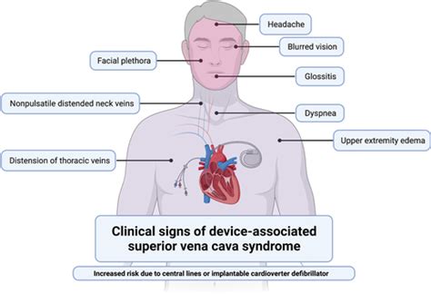 3 Cases of Superior Vena Cava Syndrome Following Percutaneous Right Ventricular Assist Device ...