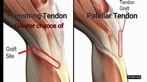 Acl reconstruction surgery hamstring graft