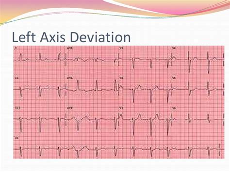 12 Lead EKG Interpretation