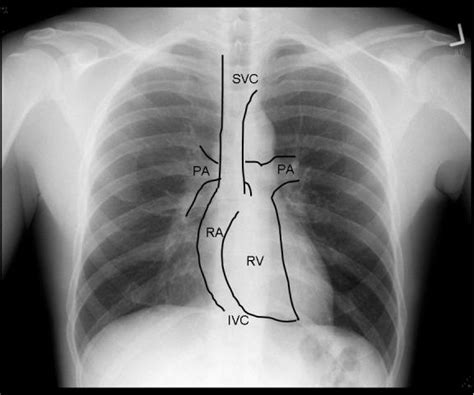 The chest x-ray in cardiovascular disease - wikidoc