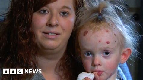 Tia has epidermolysis bullosa - known as 'butterfly skin' - BBC News