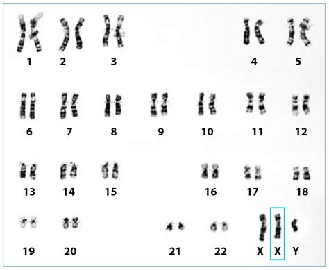 Klinefelter Syndrome