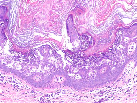 Epidermolytic Hyperkeratosis =انحلال البشرة مفرط التقرن