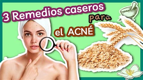 3 Remedios Caseros para el Acné - YouTube