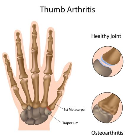 Thumb Arthritis Surgery / Basal Joint Surgery | Andrew J. Leo, MD Andrew J. Leo, M.D.