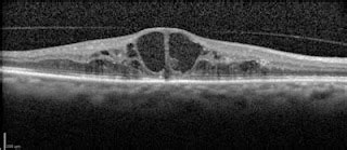 PREVENIR LA CEGUERA: HABLANDO DEL EDEMA MACULAR DIABETICO...