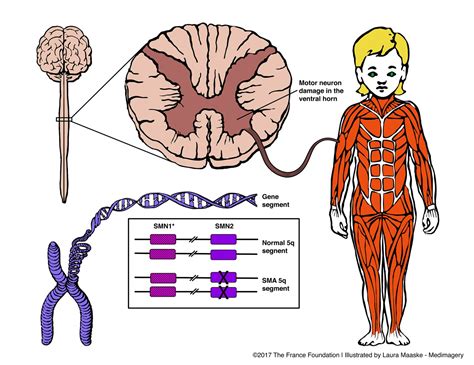 Spinal-Muscle-Atrophy-6colored-small - Medical Illustrations ...