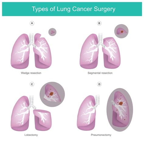 Premium Vector | Types of lung cancer surgery illustration the lung 4 ...