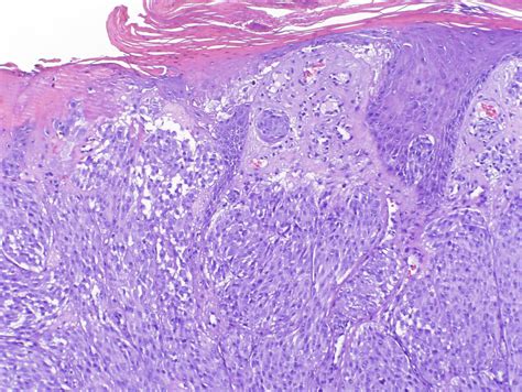 VIRTUAL GRAND ROUNDS IN DERMATOLOGY 2.0: Atypical Spitz Nevus