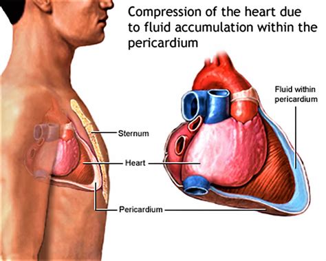 Cardiac tamponade causes, signs, symptoms, diagnosis and treatment