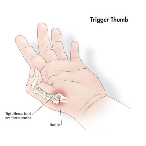 Diagram Trigger Finger Exercises