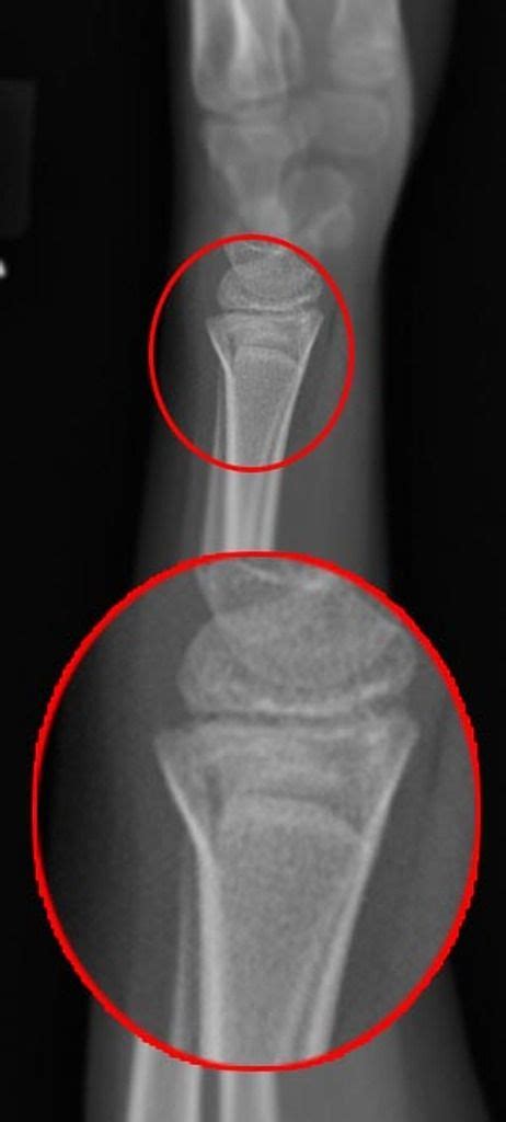 Torus fracture | Radiology Case | Radiopaedia.org | Radiology, Pediatric radiology, Nuclear medicine