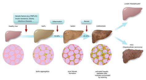 Nonalcoholic Fatty Liver Disease - DiseasesAndConditions.net