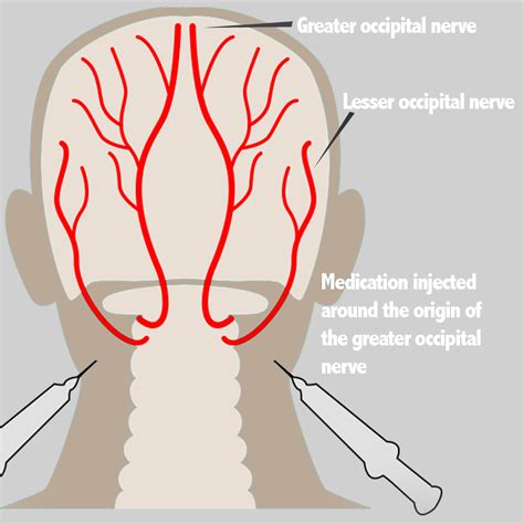 Nerve Blocks - Face Facts