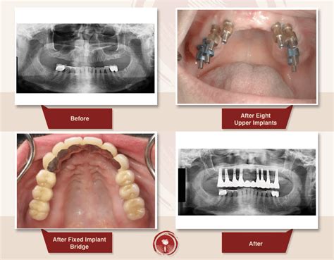 Bone Grafting Smile Gallery: Sinus Lift Bone Graft | Ramsey A. Amin, DDS