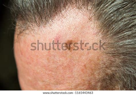 Lentigo Maligna Melanoma Situ On Forehead Stock Photo 1165443463 ...