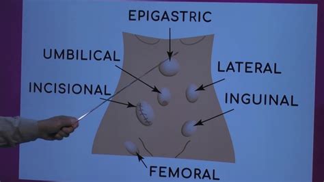 Epigastric Hernia Types