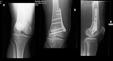 The Knee Clinic - Knee Osteotomy