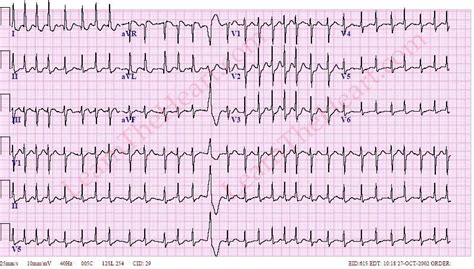 Atrial fibrillation | Bangkok Heart Hospital