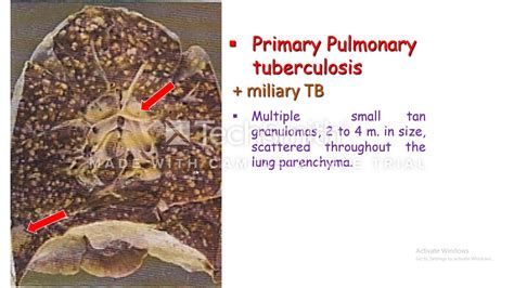 Miliary Tuberculosis - YouTube