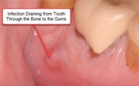 What Causes Root Canal Infections and Failure? - Integrative Dentistry, San Diego Holistic Dentist