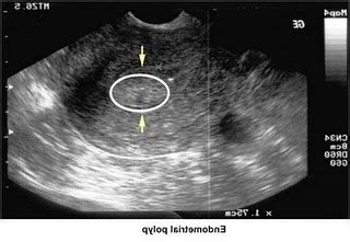 Uterus (neck) polyps ~ All About Women Health