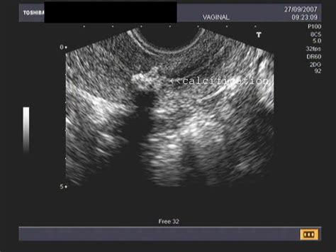 A Gallery of High-Resolution, Ultrasound, Color Doppler & 3D Images - Uterus