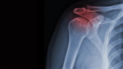 Can you fracture your shoulder blade? | Reflex Health