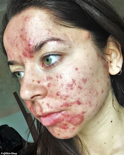 Personal trainer who had the 'worst acne ever seen' shares her striking ...