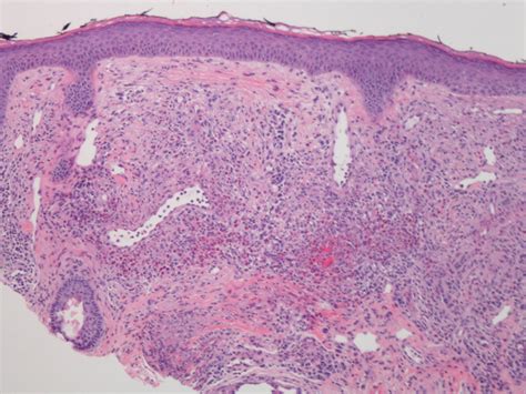 Granuloma faciale: Case report and review