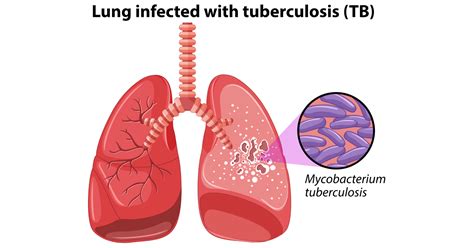 Tuberculosis: Symptoms, Causes, Treatment & Prevention