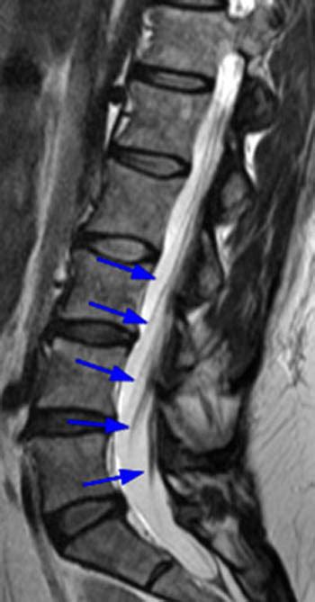 Arachnoiditis - Radsource