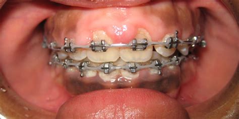 Swollen Gums, Overgrown gingiva during Orthodontic Treatment: Causes ...