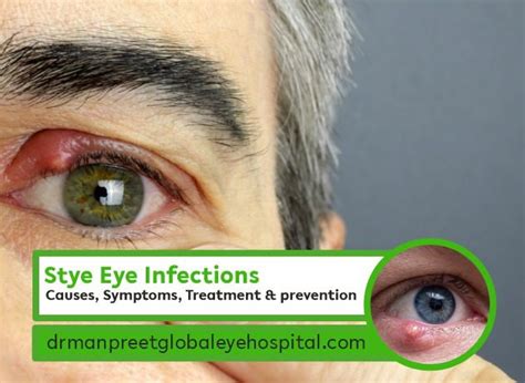 Causes, Symptoms, Treatment and prevention of Stye eye infections ...