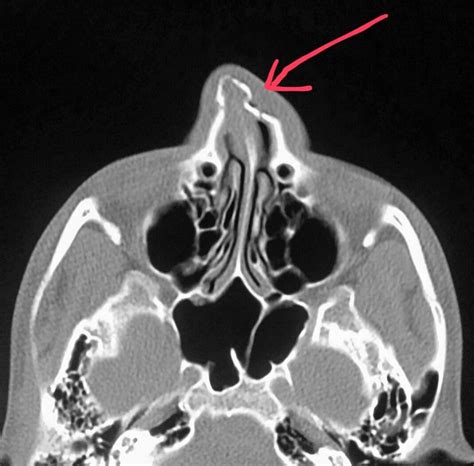 Nasal Bone Fracture Mri - Nasal bone fracture | Radiology Case | Radiopaedia.org - High ...