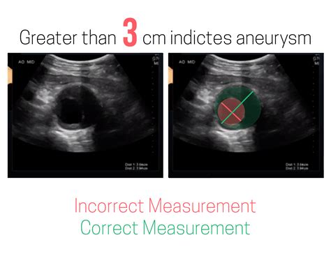 Ultrasound Leadership Academy: Aortic Ultrasound — EM Curious