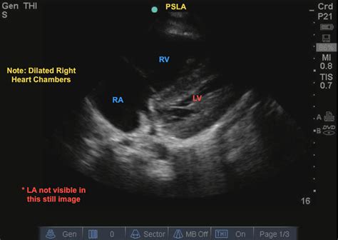 mcconnell sign Mcconnell pulmonary embolism bmj casereports - IMAGE FLUENT