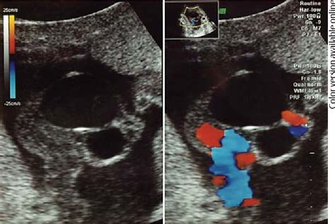 Figure 1 from Umbilical Cord Cysts of Allantoic and Omphalomesenteric ...