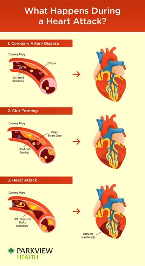 Having A Chest Pain It Can Be Heart Attack, Learn 6 Symptoms