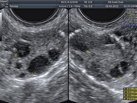 The Normal Ovary (Changes in the Menstrual Cycle) | Radiology Key