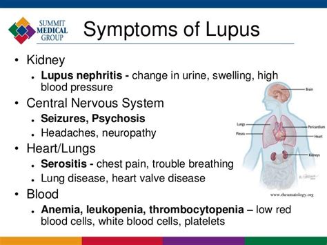 Lupus