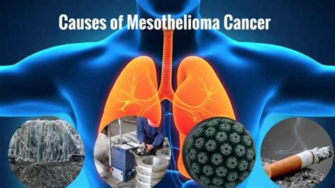 What Causes Mesothelioma | Mesothelioma Lawsuit