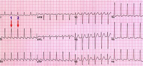 Step 1: Determine the heart rate