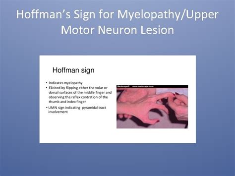 Hoffman sign neuro 331243-Hoffman sign upper motor neuron - Saesipapictxsq